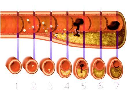 Peter Libby's rendition of atheromatous progression